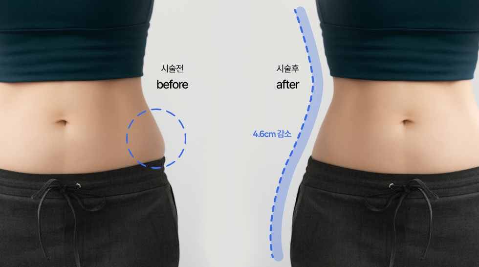 둘레 4.6cm 감소